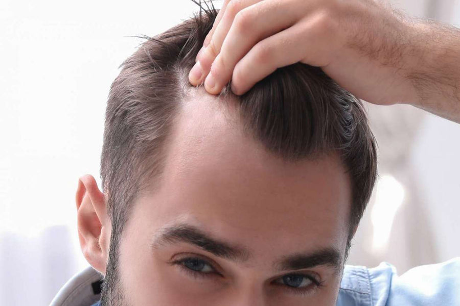 Receding Hairline