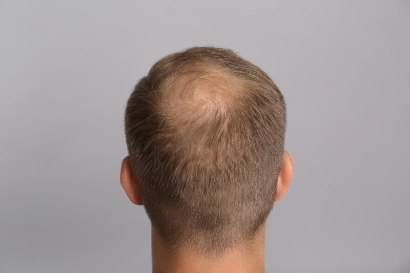 Thinning Crown